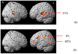 fMRI of Brain or Tinnitus sufferer during ADT